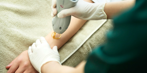 テスト照射とパワー調整で肌負担にこだわる
