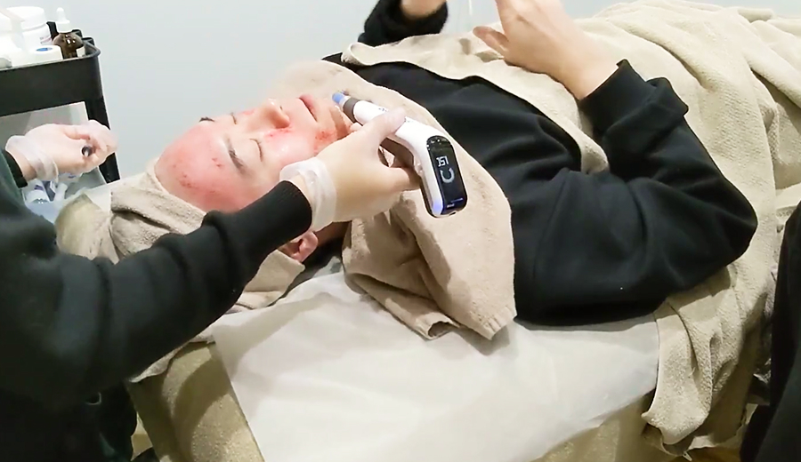 ダーマペン4の施術の様子