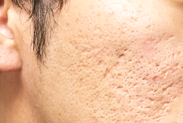 毛穴の開き改善のイメージ