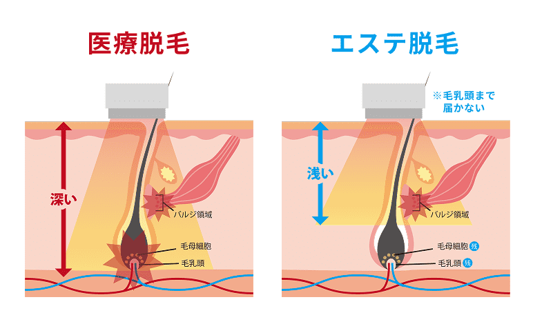 医療脱毛とエステ脱毛の違い